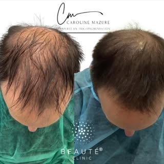 ✨ Avant / Après Tricopigmentation – Effet Densité ✨
Un nouveau look, plus dense et plus structuré, g