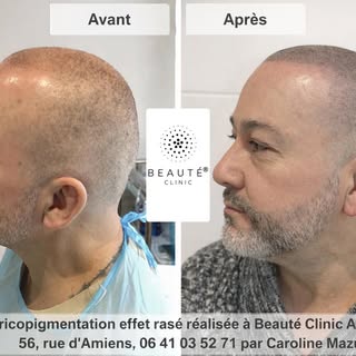 ✨ Tricopigmentation effet rasé : un résultat naturel et masculin ✨

Vous souhaitez retrouver l’appar
