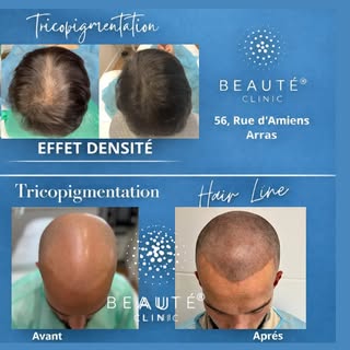 AVANT / APRÈS – TRICOPIGMENTATION 

Résultat visible et naturel grâce à la tricopigmentation, une so