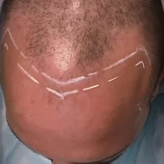 🔥 Et si vous retrouviez une vraie ligne capillaire en seulement 3 mois ? 🔥

La Tricopigmentation e