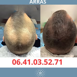 Tricopigmentation & Solution Calvitie à Arras 

Vous souffrez de perte de cheveux, de calvitie ou de