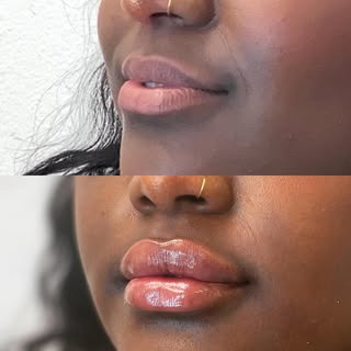 This babes lips are so fire they will forever live on my page. 
#lipfiller #stgeorgeinjector #southe
