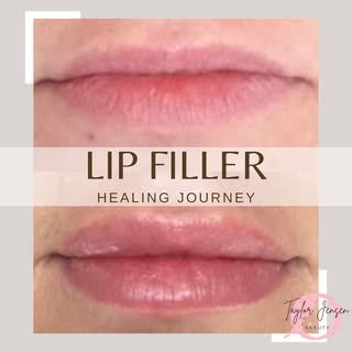 Not sure what to expect after lip filler? Come along on my lip filler healing journey. Everyones bod