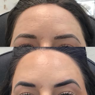 L👀K at that brow lift 😳Just a few units of strategically placed daxxi lifted her upper eyelids and