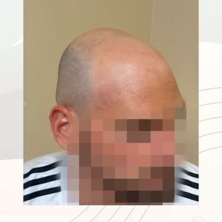 Hay una zona que suele ser la más delicada: la línea frontal. 📏
Demasiado definida y parece artific