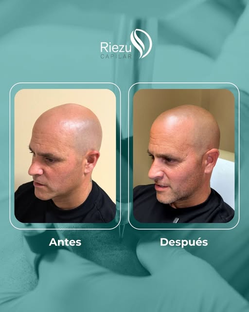 ✨ Micropigmentación capilar de Sergio.

De cuero cabelludo completamente visible a un efecto rapado 