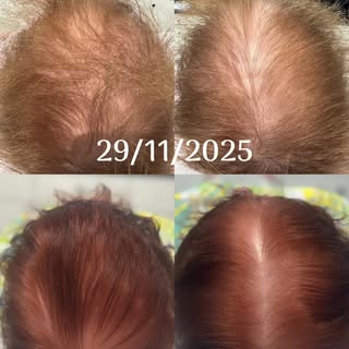 ✨ 8 miesięcy terapii trychologicznej – efekty, które mówią same za siebie.

Na zdjęciach widzicie po