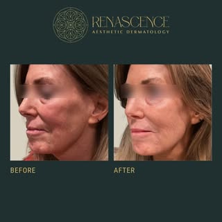 Subtle, natural refresh 6 weeks later ✨
This beautiful patient had:
• 2 vials of Sculptra
• A touch 