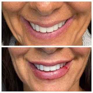 I spent the day doing more #fillers and #botox training it was so much fun #aesthetic #lips #aesthet
