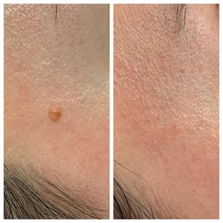#moleremoval #nofilter Come See Me @omlportland #pdx #aesthetic