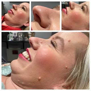 Come see me @omlportland for #moleremoval  #pdx  #aesthetics  #pnw  #cosmetic  #medspa