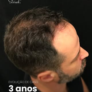 Kleiton, 46 anos, de Canoas, com 3 anos de evolução do transplante capilar. Cada caso carrega uma hi