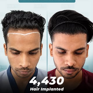 Designer Hairline or Customised Hairline, call it what you like.
At DHI, every hairline is a perfect
