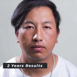 Amazing Hair Transplant Results | 2 Years Hair Transplant Results | Hair Transplant Before After 🔥�