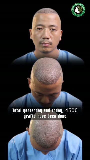 Say goodbye to hair loss and hello to renewed confidence! 
Watch how our client overcame years of ha