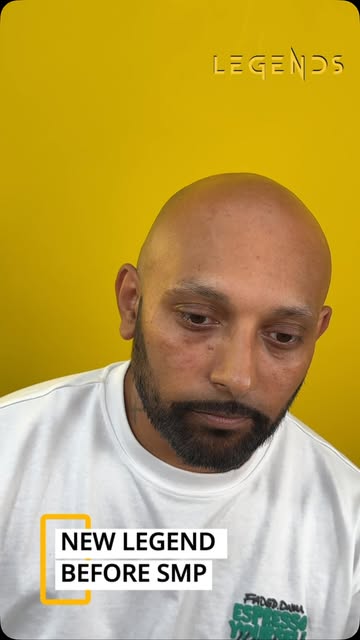 We’ve added a new Legend to the ranks. 

When this client first came in, hair loss was making him fe