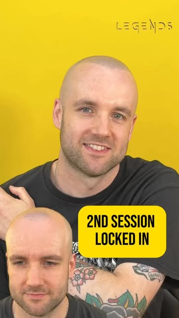 That 2nd session feeling ! 

Hair loss liberation is fully here ! 

And hair loss worries are also g