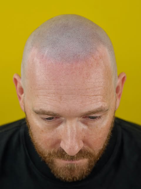 Before and after 2nd session. 

Feathered hairline with designer scar. 

Still a working progress, s