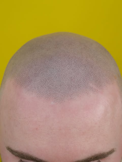 3rd session locked in and hair loss is a thing of the past ! 

This is our very popular hyper jagged