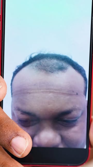 Porque recuperar el cabello también es recuperar seguridad, confianza y esas ganas de volver a mirar
