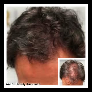 Density treatment with Scalp MicroPigmentation, SMP. Shading the scalp with tiny follicle impression