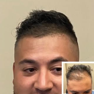 Conceal patchy hairloss with Scalp MicroPigmentation, SMP. I replace hair follicles that used to be 