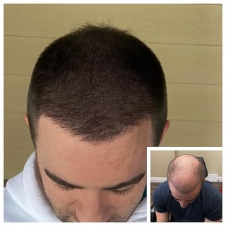 This is a combination of a hair transplant and Scalp Micropigmentation. They make a great team! #mic