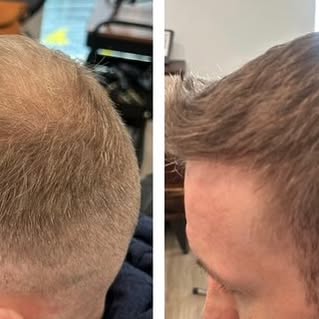 Men’s Density Treatment. By adding micro follicle impressions on the scalp it creates a shadow effec