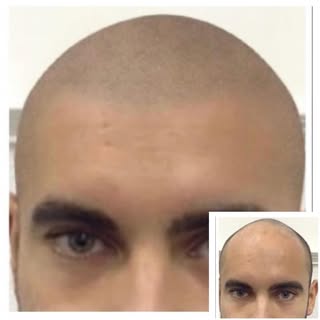 Reduce your forehead with Scalp Micropigmentation! Hats off for Summer! #microdotstudio #smputah #sc