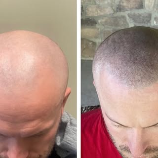 Adding follicle impressions into the male pattern balding areas creates a full looking head of hair.