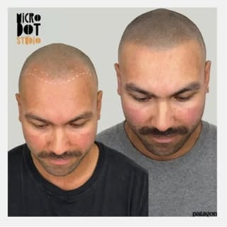 Hats Off For Summer! 🧢 Scalp Micropigmentation (SMP)restores your hairline without surgery or downt