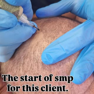 Balding on the crown happens to most men , But there is a solution it’s called scalp micro pigmentat