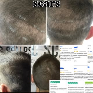 Far too many people are having hair transplants, that lead to scaring or more often than not it just