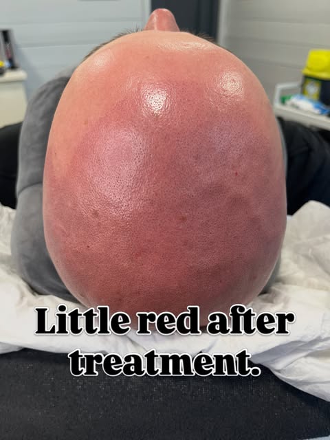 Straight after the session, the Smp is red I’ve reduced the redness using Ai to show what it will lo