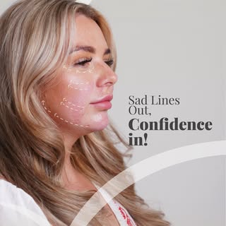 Today, we had the pleasure of treating Ms. Emma with our signature full-face filler approach 💉✨

He