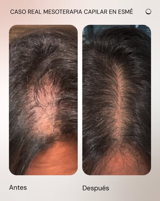 ✨ Caso real de mesoterapia capilar en esmé ✨

En estas imágenes, podemos ver la evolución de una pac