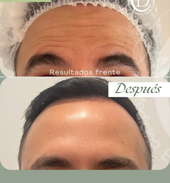 𝗥𝗘𝗦𝗨𝗟𝗧𝗔𝗗𝗢 𝗡𝗘𝗨𝗥𝗢𝗠𝗢𝗗𝗨𝗟𝗔𝗗𝗢𝗥

Rejuvenecimiento inmediato, y la mejor forma de pre