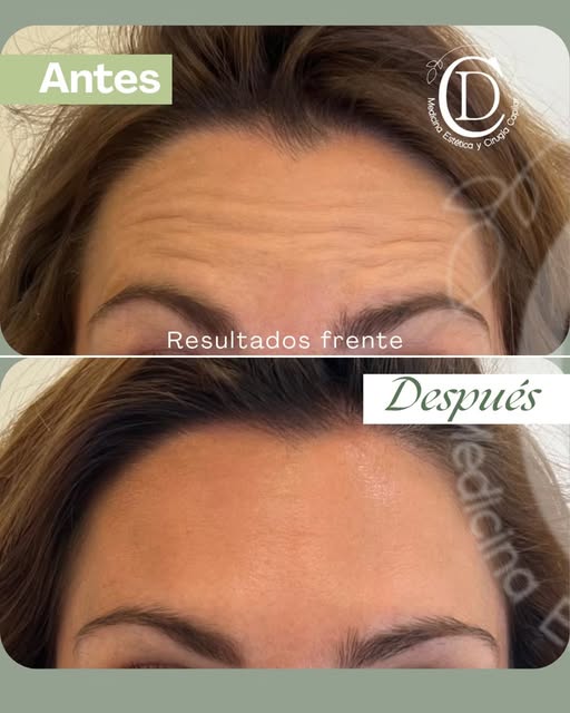 𝗔𝗡𝗧𝗘𝗦 𝗬 𝗗𝗘𝗦𝗣𝗨É𝗦 𝗗𝗘 𝗡𝗘𝗨𝗥𝗢𝗠𝗢𝗗𝗨𝗟𝗔𝗗𝗢𝗥𝗘𝗦

Antes y después exitoso en pacien