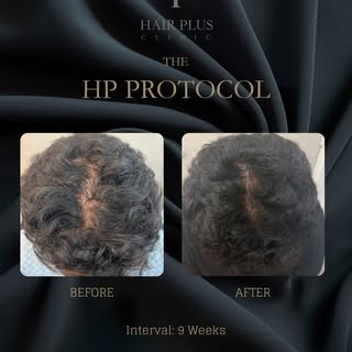 9-week clinical progress with The HP Protocol

This before-and-after image documents one client’s ha