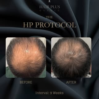 3-Month clinical progress with The HP Protocol

This before-and-after image documents one client’s h