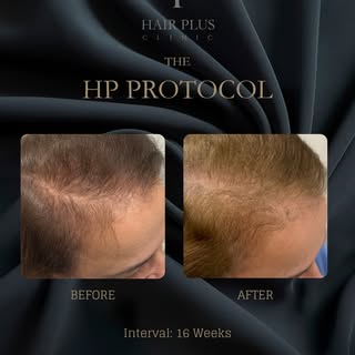 4-Month clinical progress with The HP Protocol

This before-and-after image documents one client’s h