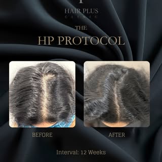 3-Month clinical progress with The HP Protocol

This before-and-after image documents one client’s h
