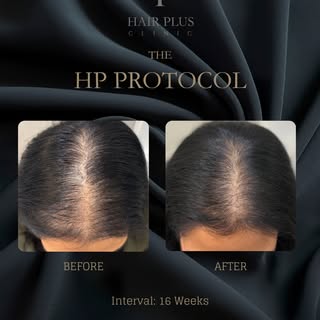 4-Month clinical progress with The HP Protocol

This before-and-after image documents one client’s h
