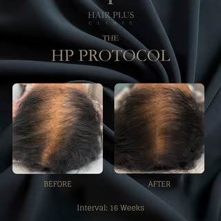 4-Month clinical progress with The HP Protocol

This before-and-after image documents one client’s h