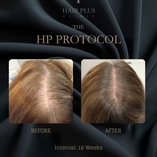4-Month clinical progress with The HP Protocol

This before-and-after image documents one client’s h