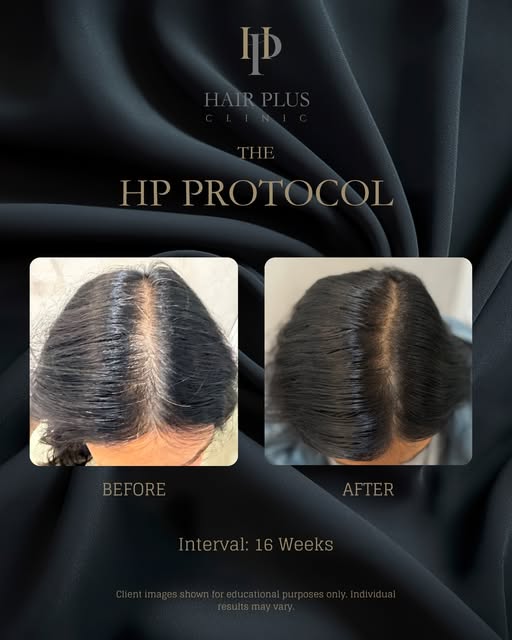 4-Month clinical progress with The HP Protocol

This before-and-after image documents one client’s h