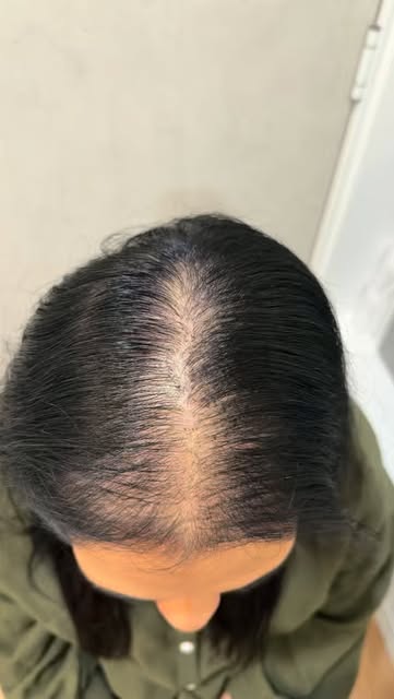 4 MONTHS OF CONSISTENCY 📈

A look at this client’s hair and scalp progress over 4 months.

Hair con