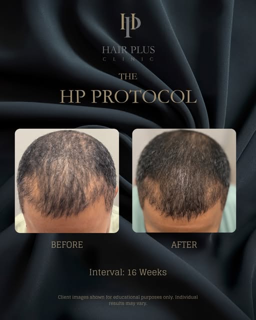 4-Month clinical progress with The HP Protocol

This before-and-after image documents one client’s h