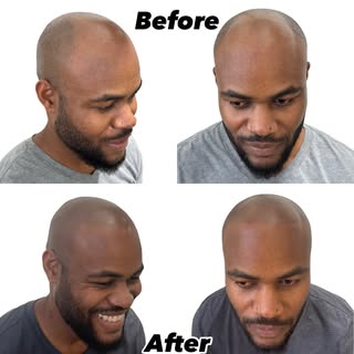 They pure joy when my clients are done with their last #SMP session. 

#ScalpMicropigmentation #Hair