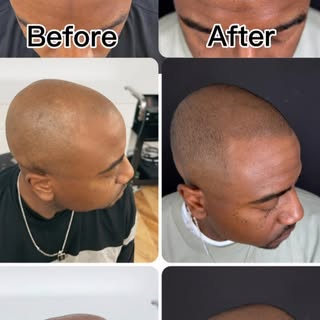 He was tired of hiding under hats. He just wanted his confidence back.

Density work. Natural. Undet